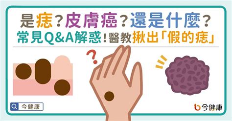 男生臉上很多痣|是痣or皮膚癌？醫「1張圖秒對照」 長這2部位最危險